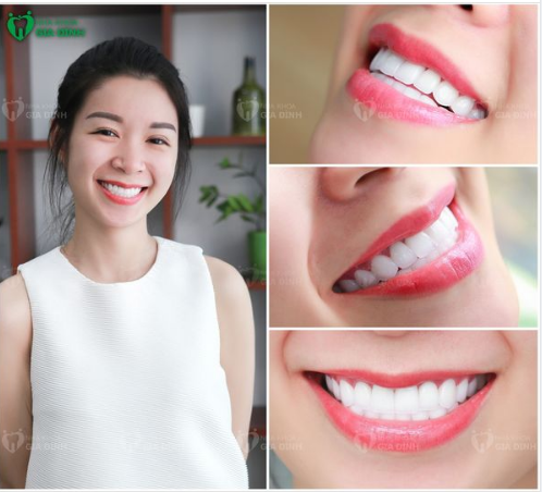 Hàm răng không tì vết như thế này thì chỉ có làm tại Nha khoa Gia Đình thôi