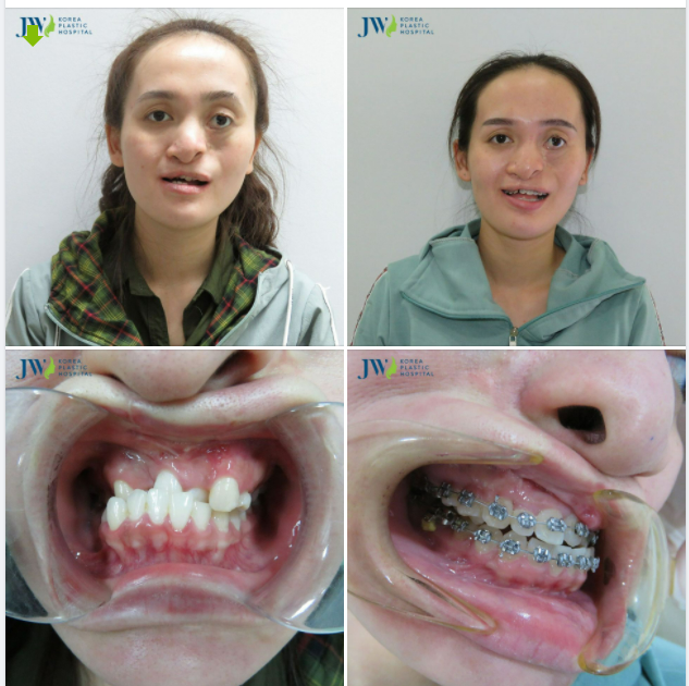 HẠNH VIÊN cô gái đến từ PHÚ YÊN và HÀNH TRÌNH thoát kiếp nạn DỊ TẬT SỨT MÔI HỞ HÀM ẾCH bẩm sinh