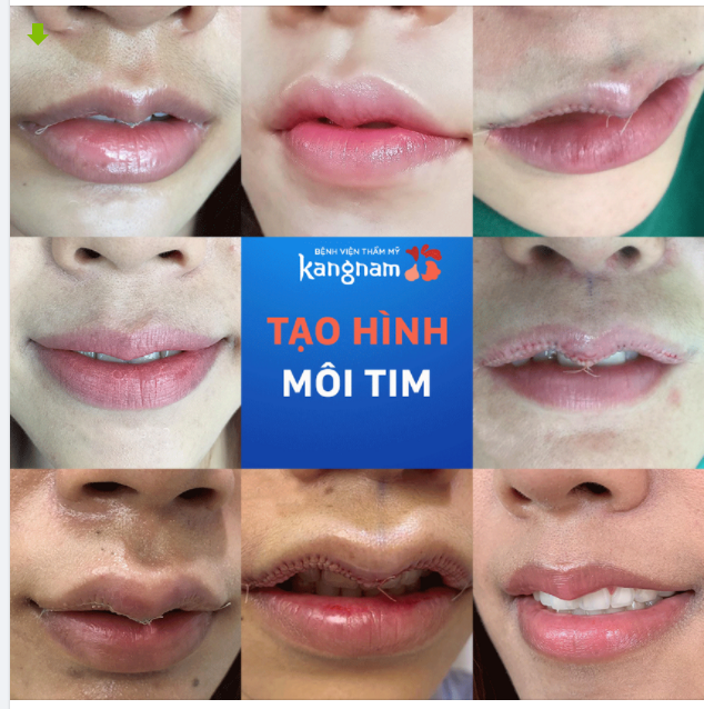 Hãy cùng nhìn ngắm những ca tạo hình môi tim thành công tại BVTM Kangnam.