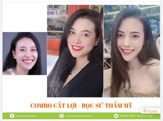 HẾT HỞ LỢI - NỤ CƯỜI TRẮNG SÁNG CHỈ SAU 3 LẦN GHÉ VIET SMILE