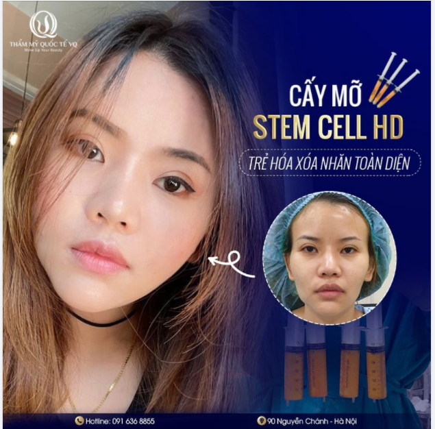 Hết má hóp, thái dương lõm - Trẻ hóa toàn diện cùng Bs Vũ Quang