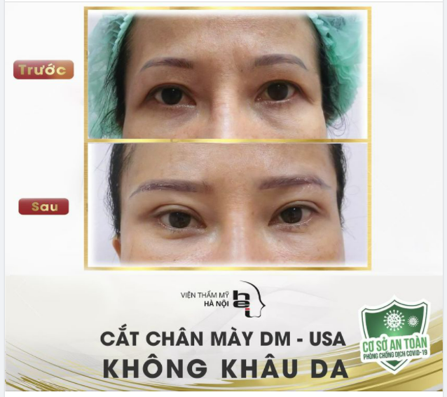 HẾT SỤP MÍ - MẮT TƯƠI TRẺ NGAY LẬP TỨC Nhờ cắt da chùng chân mày DM - USA