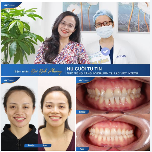 HẾT THƯA, XÔ LỆCH, VẺ ĐẸP ĐƯỢC NÂNG CẤP HOÀN HẢO SAU KHI NIỀNG RĂNG INVISALIGN