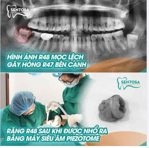 HIỂM HOẠ KHÔN LƯỜNG TỪ CHIẾC “RĂNG KHÔN”