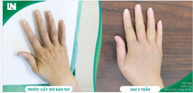 HÌNH ẢNH SAU 2 TUẦN CẤY MỠ BÀN TAY