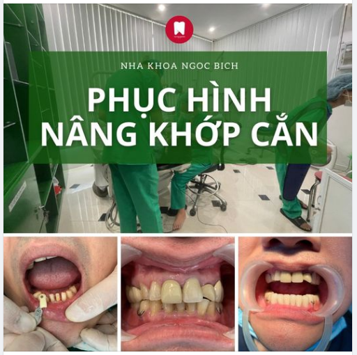 HÌNH ẢNH TRƯỚC VÀ SAU PHỤC HÌNH NÂNG KHỚP CẮN