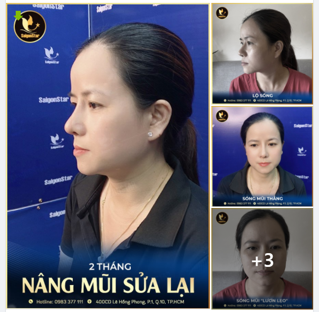 HÔ BIẾN NHỮNG CHIẾC MŨI HỎNG THÀNH CHIẾC MŨI ĐẸP CÙNG BÁC SĨ HOẠT