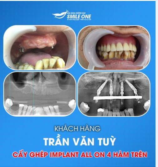 HOÀN THIỆN CASE CẤY GHÉP IMPLANT ALL- ON - 4