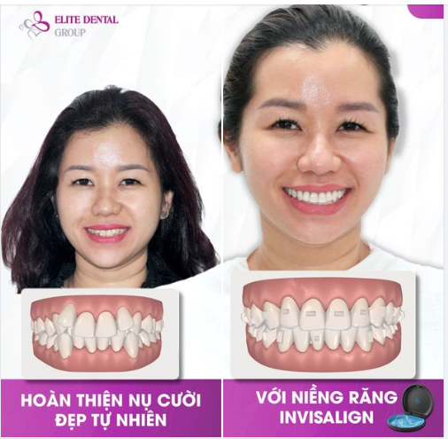Hoàn thiện nụ cười đẹp tự nhiên với niềng răng Invisalign và tẩy trắng