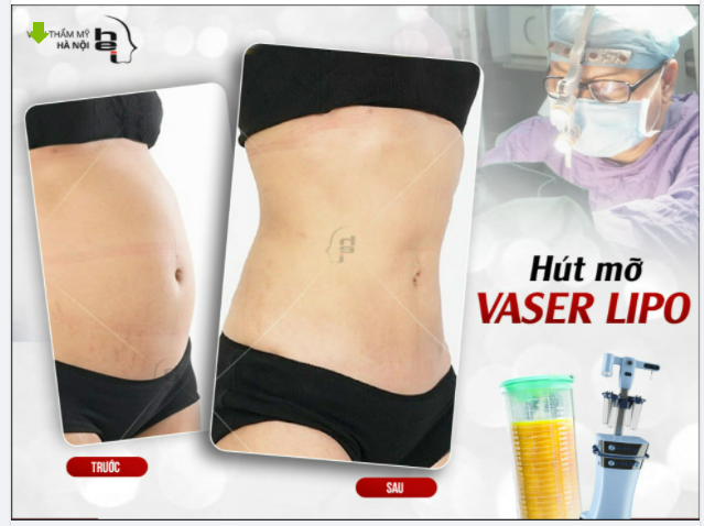 HÚT MỠ BỤNG VASER LIPPO