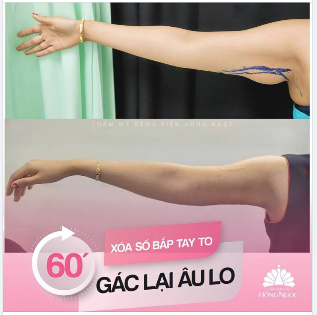 HÚT MỠ CÁNH TAY - THON GỌN NGAY CHỈ SAU 60 PHÚT