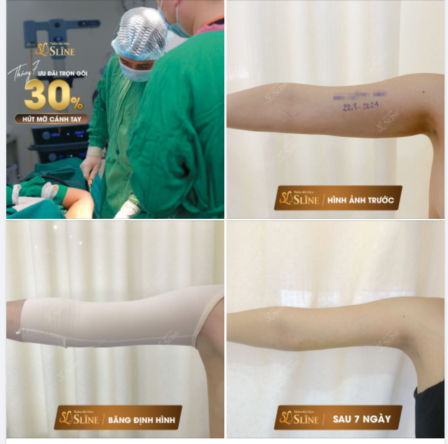 HÚT MỠ CÁNH TAY - ƯU ĐÃI NGAY 30%
