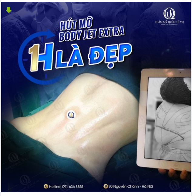 Hút mỡ, thu cơ - Bụng đẹp như mơ