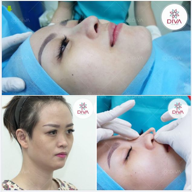 KẾT QUẢ NÂNG MŨI HÀN QUỐC: MŨI CAO TINH TẾ, TẠO ĐIỂM NHẤN CHO GƯƠNG MẶT