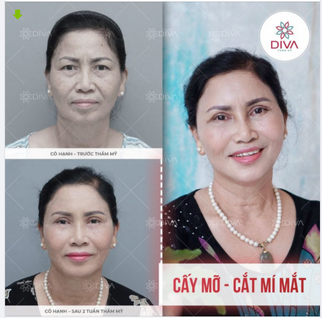 KẾT QUẢ SAU THẨM MỸ CẤY MỠ COLEMAN, CẮT MÍ MẮT