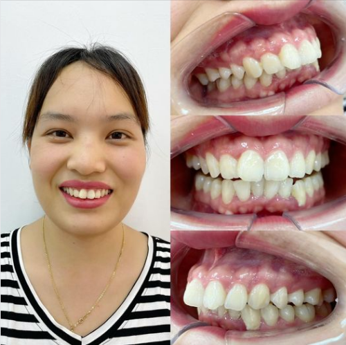 Khắc phục các nhược điểm về răng để nụ cười tự tin hơn, rạng ngời hơn bạn không nhất thiết phải làm răng sứ thẩm mỹ.