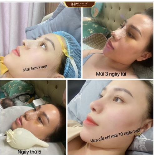KHÁCH HÀNG CHIA SẺ VỀ BĂN KHOĂN “SAU KHI SINH CON” CÓ NÊN NÂNG MŨI CỦA CÁC CHỊ EM ?