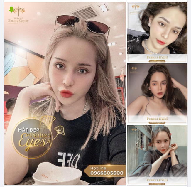 Khách hàng làm Perfect Eyes tại Thẩm mỹ Beauty Center by Tấm để có đôi mắt to tròn, long lanh và hút hồn.