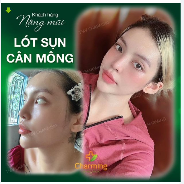 Khách hang  nâng mũi lót sụn cân mông