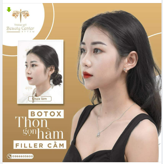 Khách hàng sử dụng dịch vụ Botox thon gọn hàm và Filler cằm được lột xác với hình ảnh tươi mới và thu hút hơn!