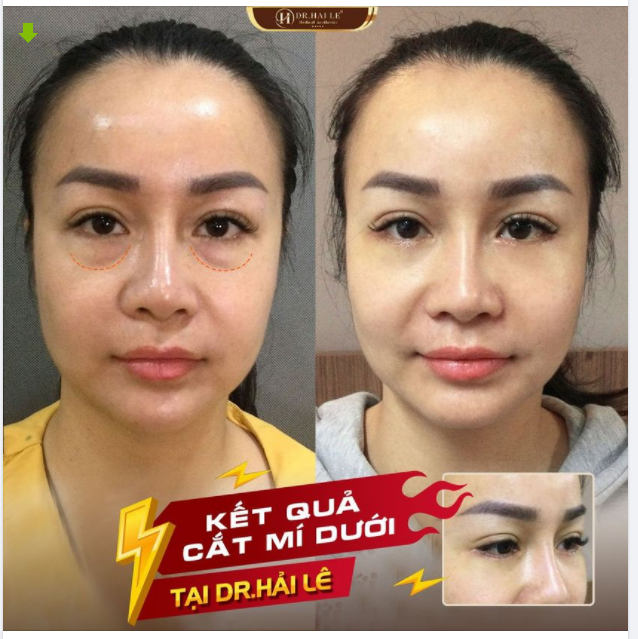 Khách hàng trẻ ra vài tuổi nhờ cắt mí dưới Mỡ thừa, bọng mắt già nua được khắc phục hoàn toàn.