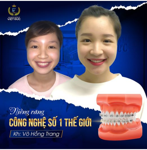 Khách hàng Võ Hồng Trang luôn cảm thấy thiếu tự tin, ngại cười nói vì hàm răng hô.