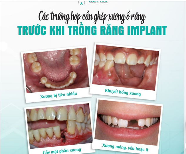 KHI NÀO CẦN GHÉP XƯƠNG Ổ RĂNG?