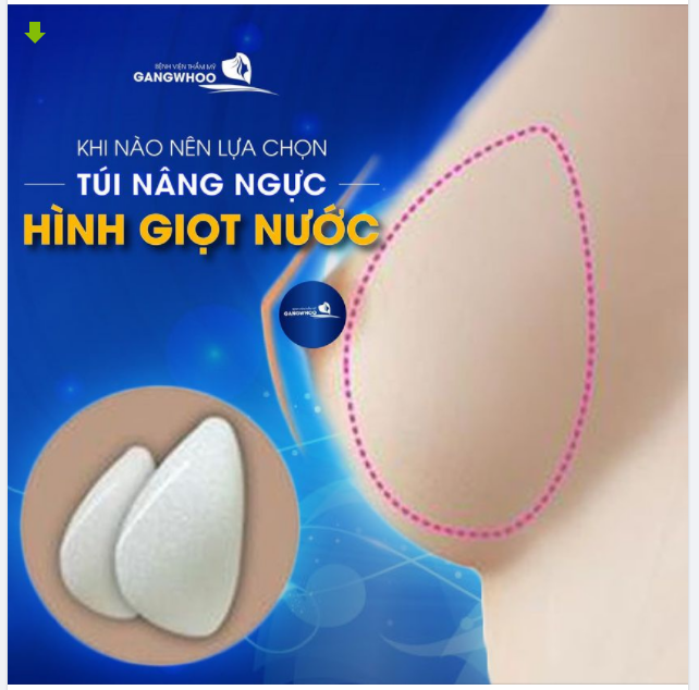 KHI NÀO NÊN LỰA CHỌN TÚI NGỰC HÌNH GIỌT NƯỚC?