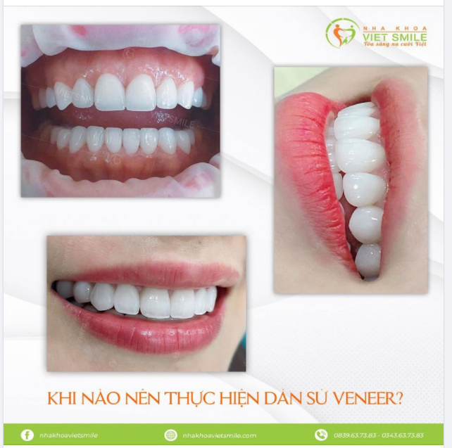 KHI NÀO NÊN THỰC HIỆN DÁN SỨ VENEER ?