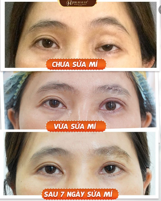 Khoe kết quả thẩm mỹ chỉnh hình sụp mí bẩm sinh tại Dr.Hải Lê 7 ngày, nhìn như hai đôi mắt khác nhau luôn ấy!