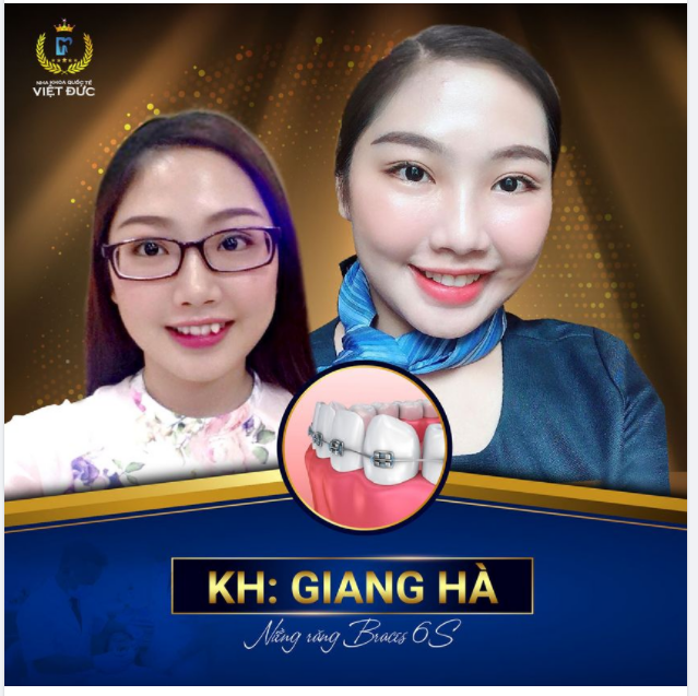 Kiên trì 2 năm sở hữu hàm răng đều đẹp là hoàn toàn xứng đáng