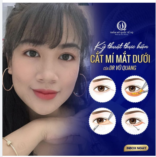 Kỹ thuật thực hiện CẮT MÍ MẮT DƯỚI của DR VŨ QUANG !