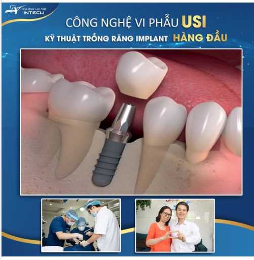 KỸ THUẬT USI - ĐỈNH CAO KỸ THUẬT TRỒNG RĂNG IMPLANT
