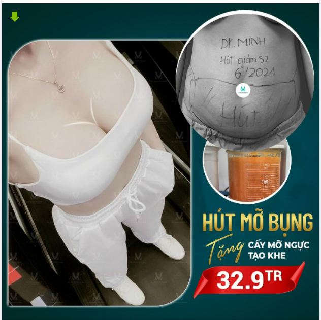 LÀM 1 ĐƯỢC 2 HÚT MỠ BỤNG TẶNG CẤY MỠ NGỰC TẠO KHE