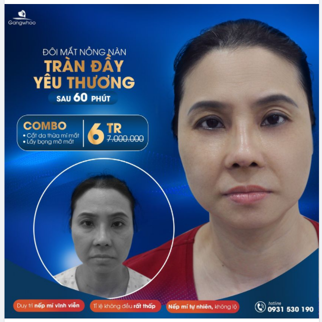 LÀM 2 TÍNH TIỀN 1 Combo cắt da thừa mí mắt lấy mỡ bọng mắt