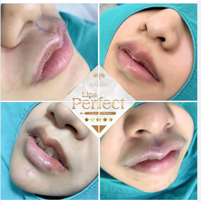 Làm Lips Perfect xong sẽ thế nào Ngắm nhìn hình ảnh thực tế của khách hàng tại Tấm để thấy rõ kết quả nhé!