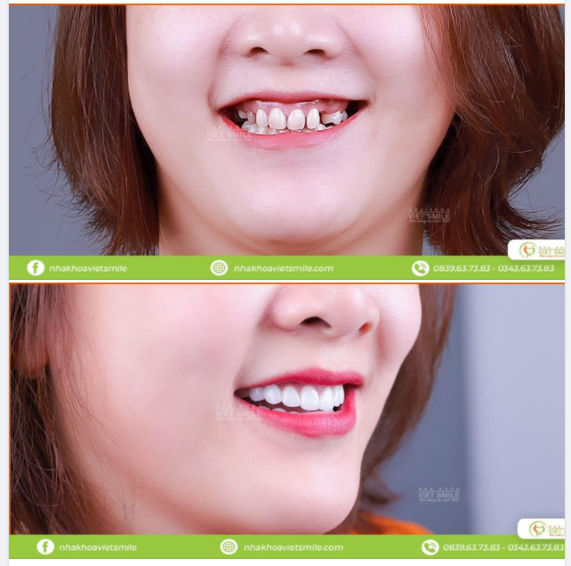 LÀM RĂNG SỨ THAY ĐỔI NHƯ THẾ NÀO?