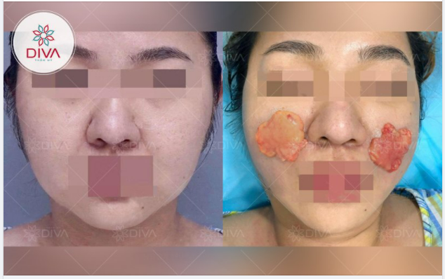LẤY TÚI MỠ MÁ - BẠN ĐƯỢC GÌ ?