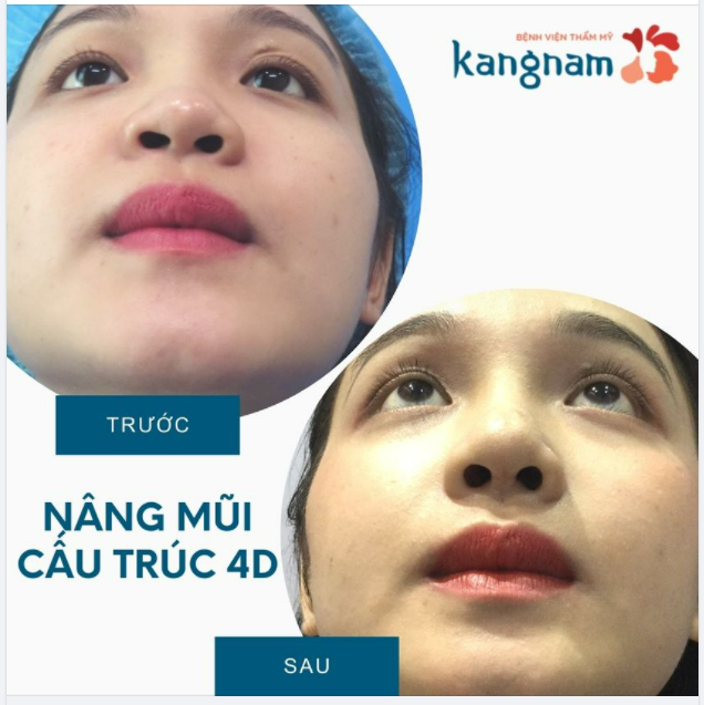 LỖ MŨI HẠT CHANH sau Nâng mũi cấu trúc 4D