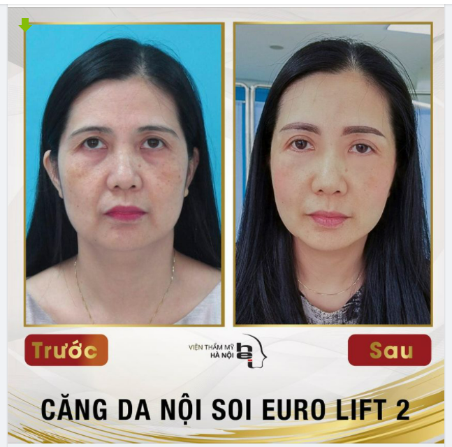 LOẠI BỎ DẤU VẾT THỜI GIAN VỚI CĂNG DA NỘI SOI EURO LIFT