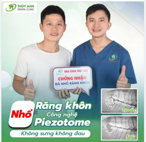 LOẠI BỎ RĂNG KHÔN - ĂN NGON KHÔNG DO BIẾN CHỨNG