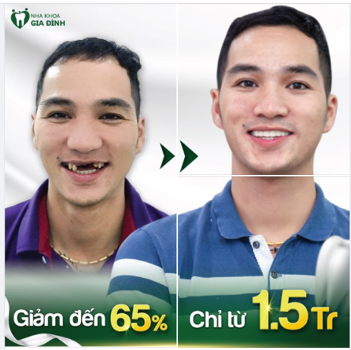 LOẠI BỎ TÌNH TRẠNG MẤT RĂNG CỬA, LẤY LẠI NỤ CƯỜI TỰ TIN