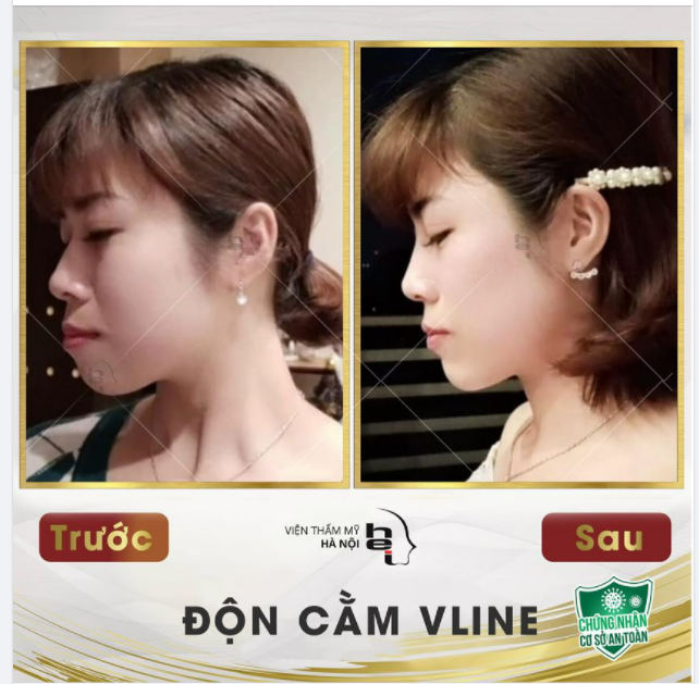 Lời chia sẻ siêu có tâm của chị gái xinh xắn với kết quả độn cằm tại Viện thẩm mỹ Hà Nội.