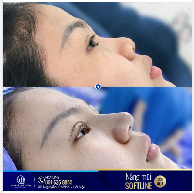 Lột xác thành công với combo hạnh phúc Nâng mũi Softline + Cắt mí baby west 9D