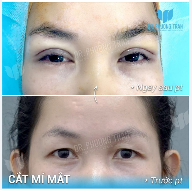 LƯU Ý QUAN TRỌNG VỀ KẾT QUẢ CẮT MÍ VỪA HOÀN THÀNH