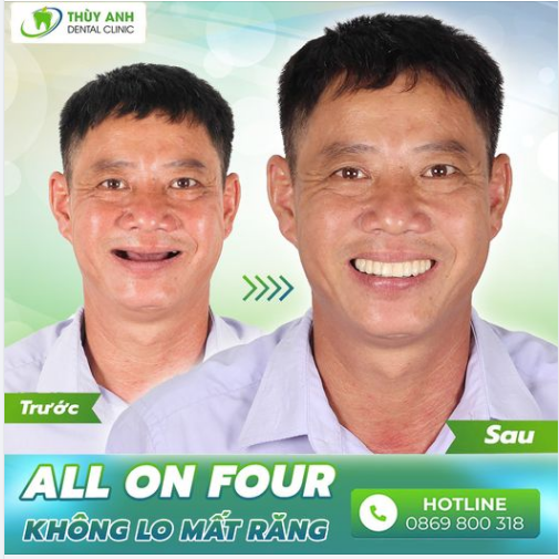 LÝ DO VÌ SAO NÊN CHỌN ALL ON 4 IMPLANT CHO CHA MẸ?