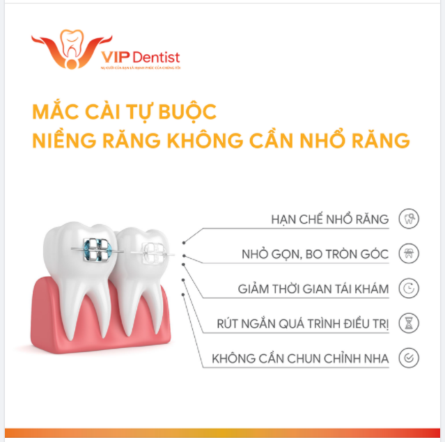 MẮC CÀI TỰ BUỘC - NIỀNG RĂNG KHÔNG NHỔ RĂNG