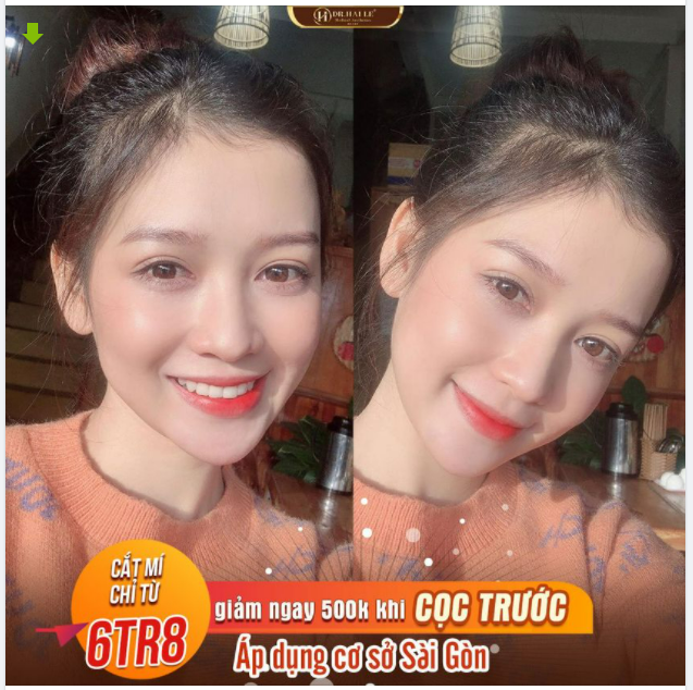 Mắt 1 mí ti hí, mí lót, sụp mí Giải pháp: Cắt mí thẩm mỹ