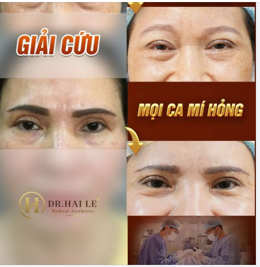 Mắt 2 mí tự nhiên ĐẸP NGAY sau  60 phút chỉnh hình Sửa mí hỏng công nghệ DeepTech20