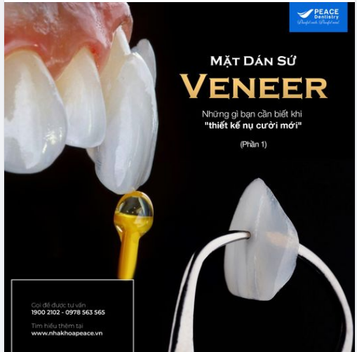 MẶT DÁN SỨ VENEER – NHỮNG GÌ BẠN NÊN BIẾT KHI QUYẾT ĐỊNH “THIẾT KẾ NỤ CƯỜI MỚI" ! (Phần 1)